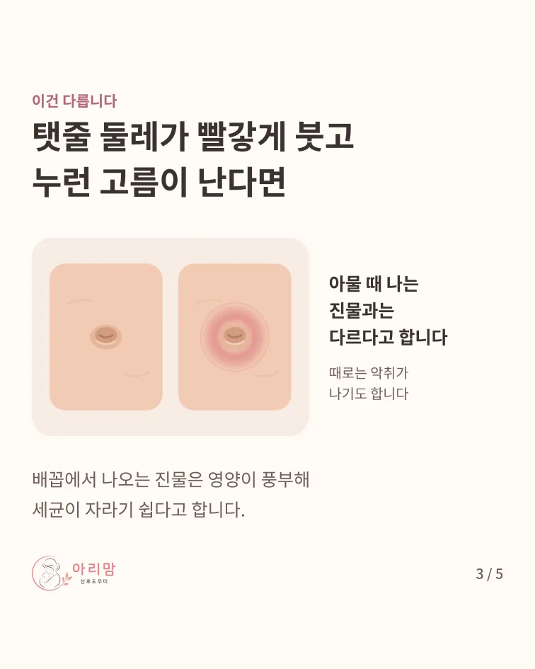 곪은 배꼽 — 진물이 아니라 곪은 것 — 탯줄 둘레가 빨갛게 붓고 누런 고름과 악취가 난다